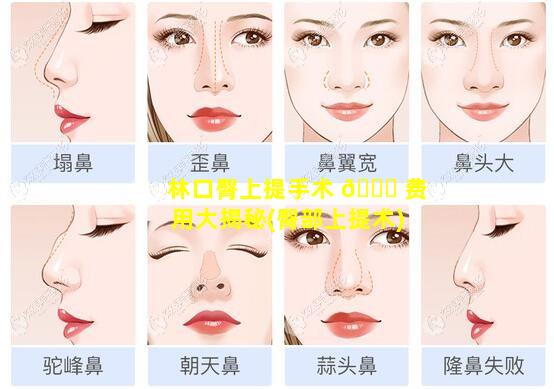 林口臀上提手术 🐞 费用大揭秘(臀部上提术)